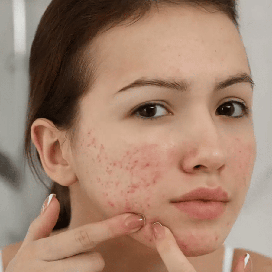 Acne | The Recovery Hub Cryotherapy