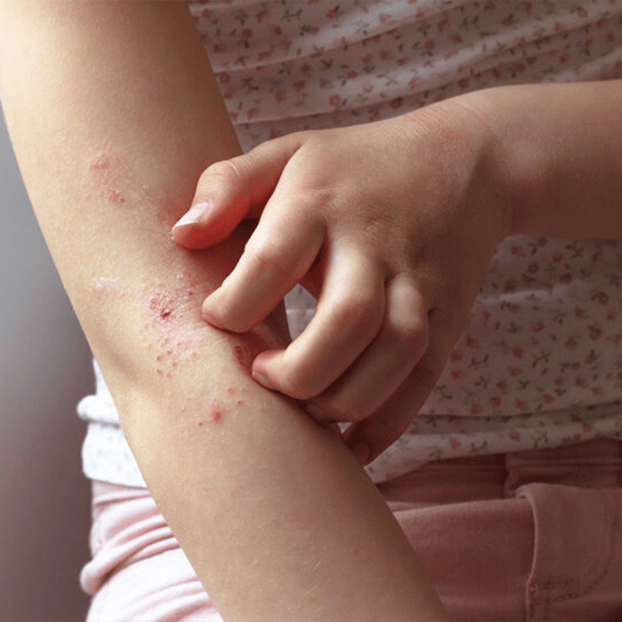 dermatitis treatments