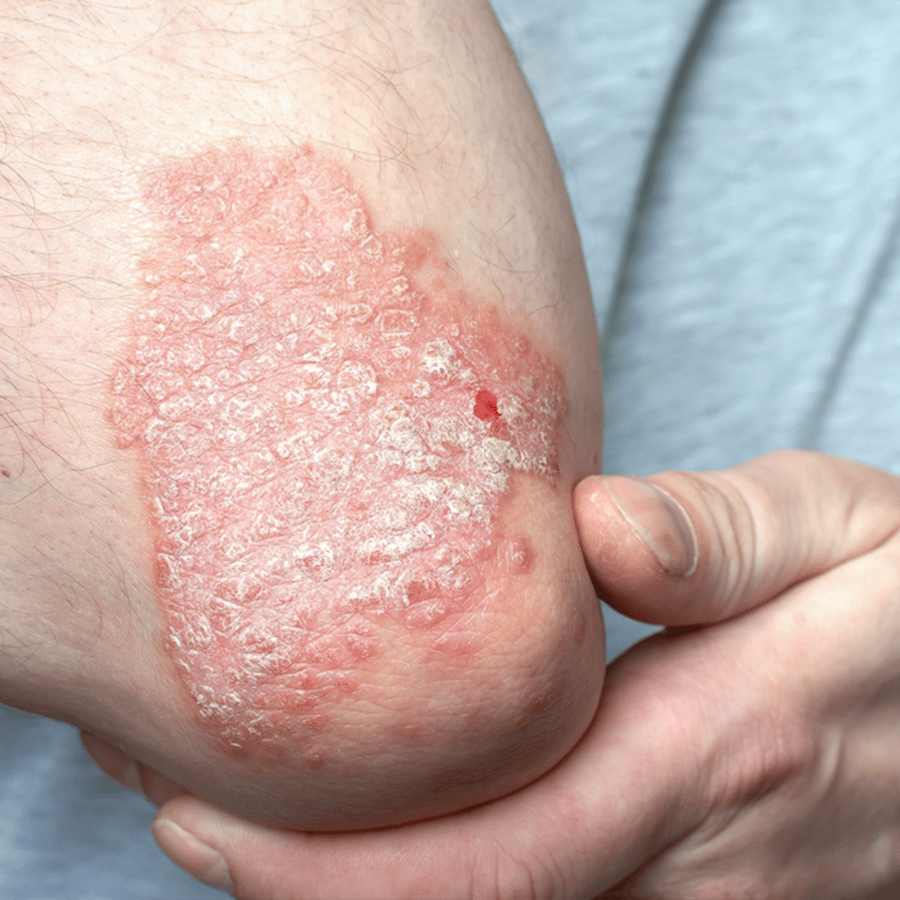 Psoriasis | The Recovery Hub Cryotherapy